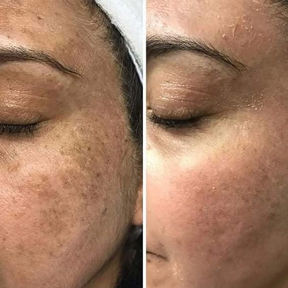 Chemical Peels For Hyperpigmentation Best Options