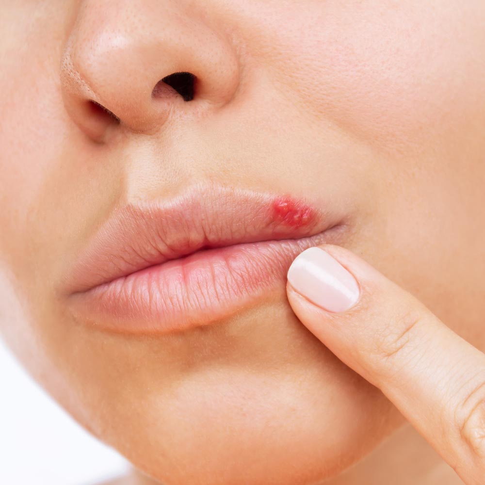 cold sore flareup