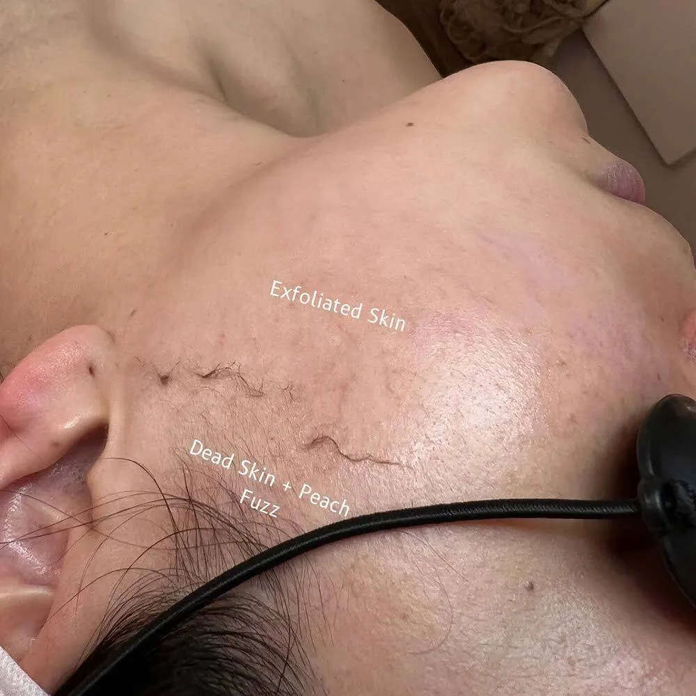 dermaplaning pros