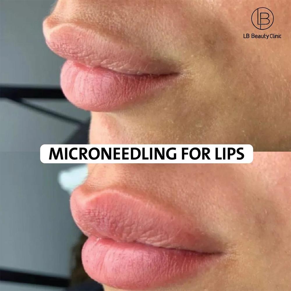 microneedling lips