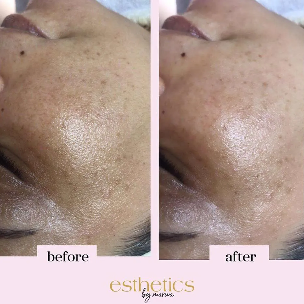 types of chemical peels for hyperpigmentation