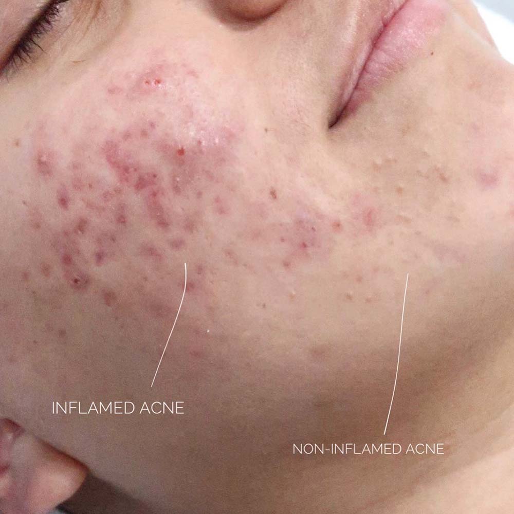 inflammatory acne 
