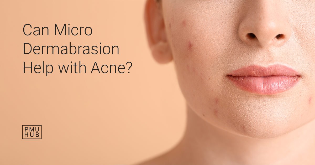 Microdermabrasion for acne and acne scars