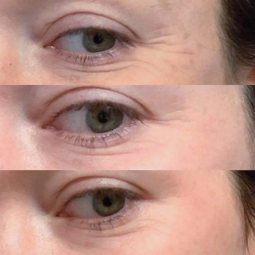 microneedling under eyes