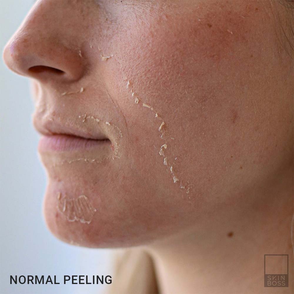 normal peeling after chemical peel