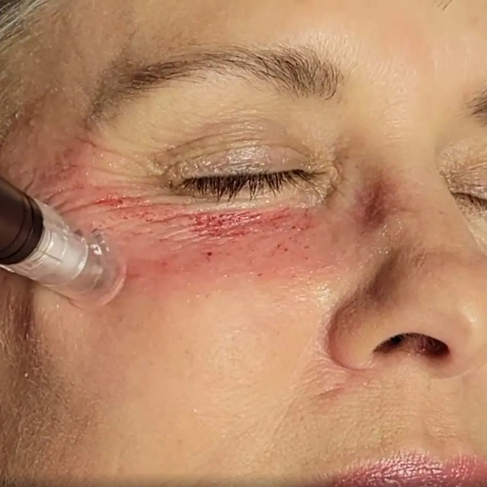 microneedling under eyes to reduce the fine lines and crepiness around eyes and improve overall skin tone and texture