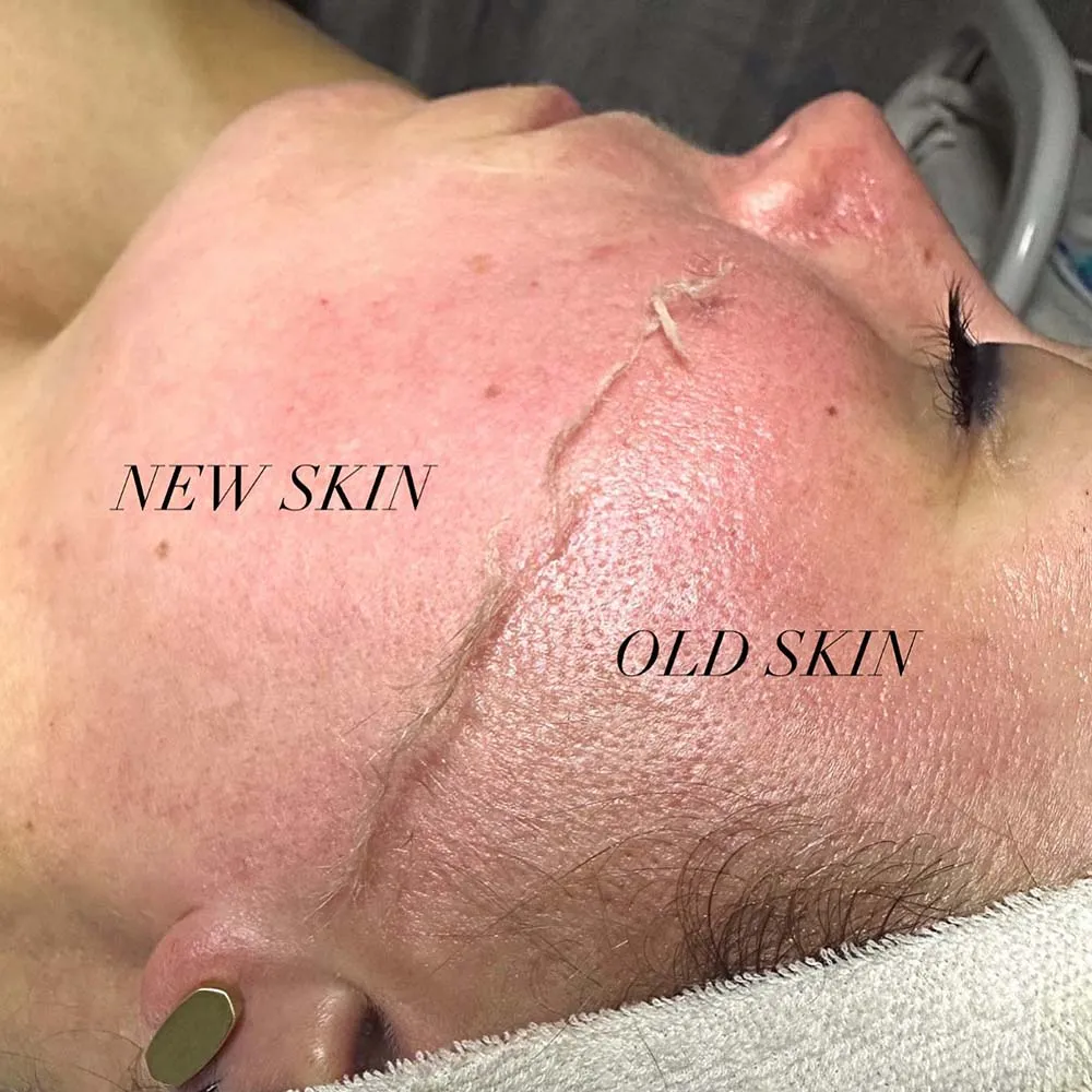 dermaplaning procedure