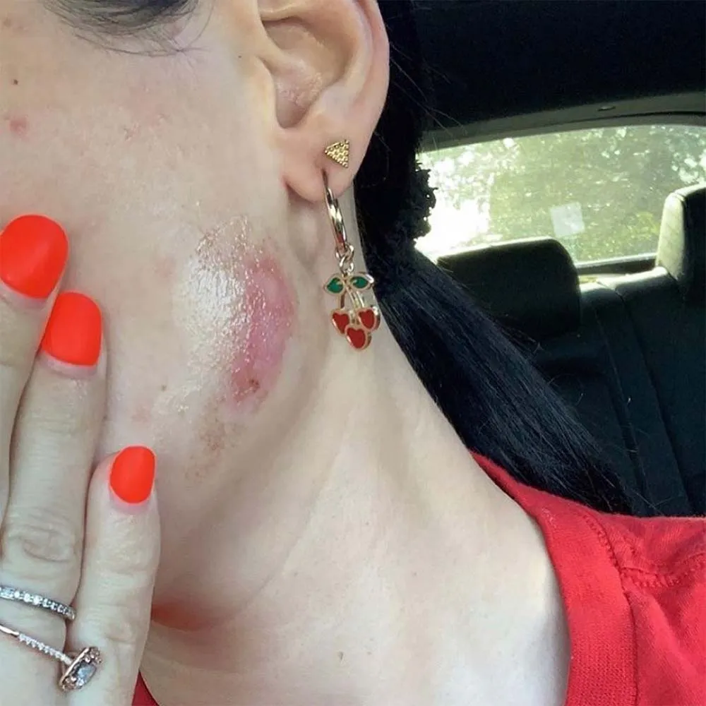 What Causes Burn Spots After Chemical Peel