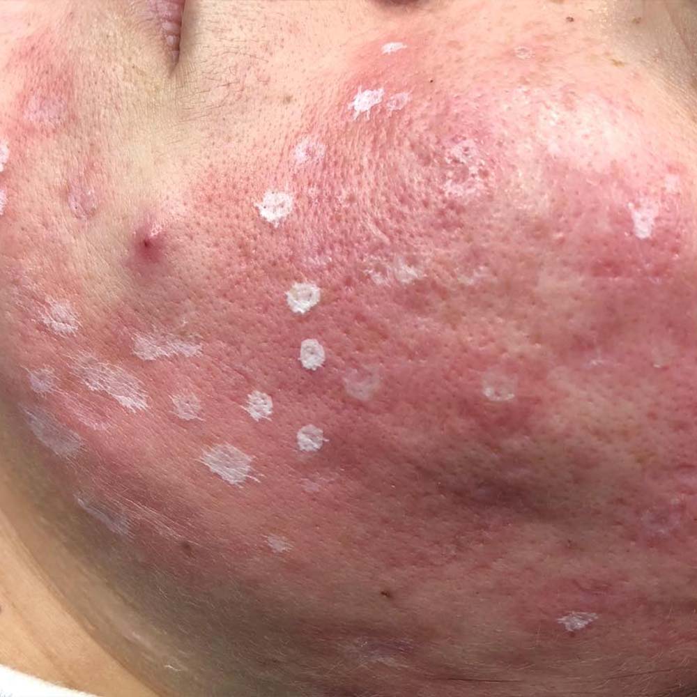 TCA peel for acne scars