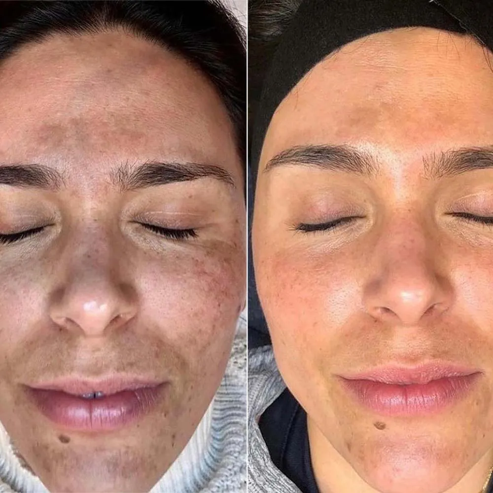 TCA Face Peel