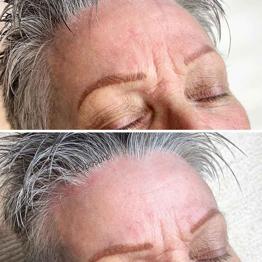 Glycolic Acid Peel for Fine Lines and Wrinkles