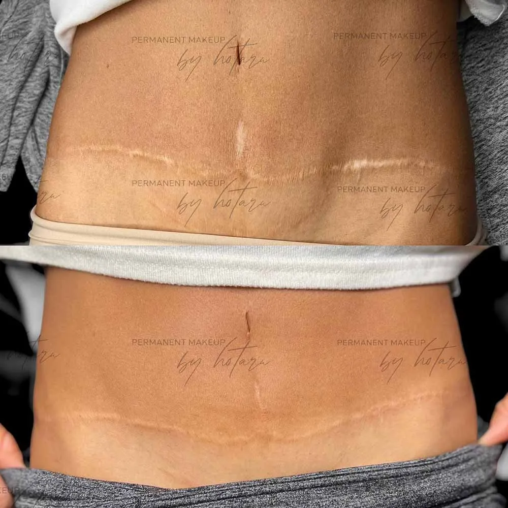 Will I have Tummy Tuck Scars?