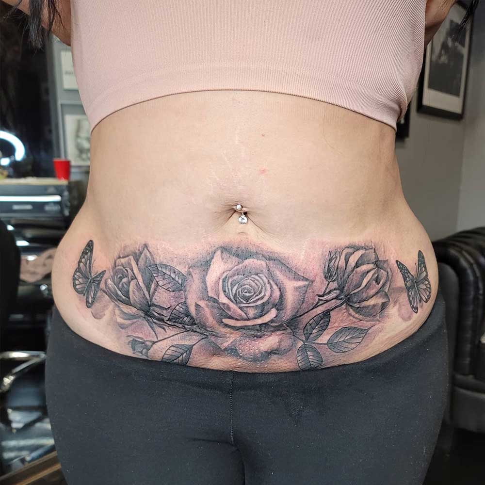 tummy tuck scar camouflage with decorative tattooing