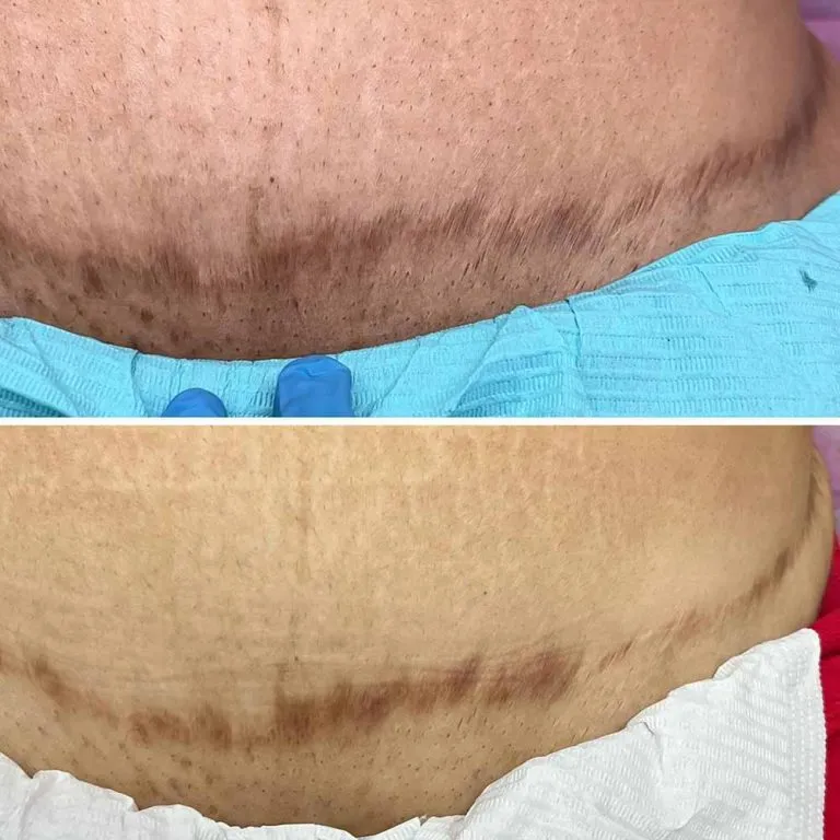 Tummy Tuck Scar Camouflage Most Popular Treatments