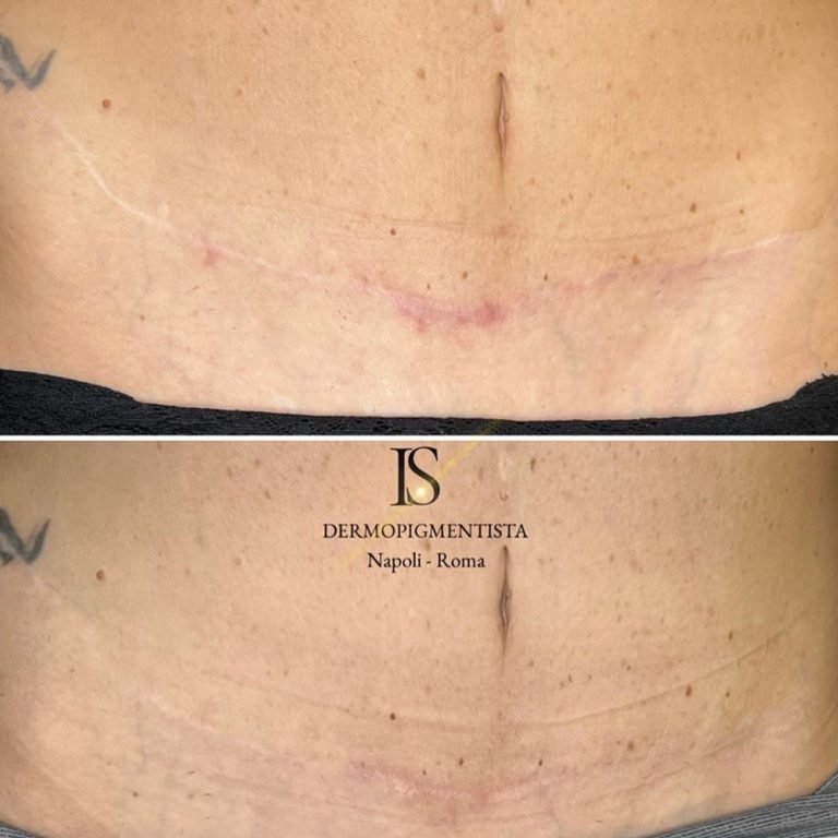 Tummy Tuck Scar Camouflage Most Popular Treatments