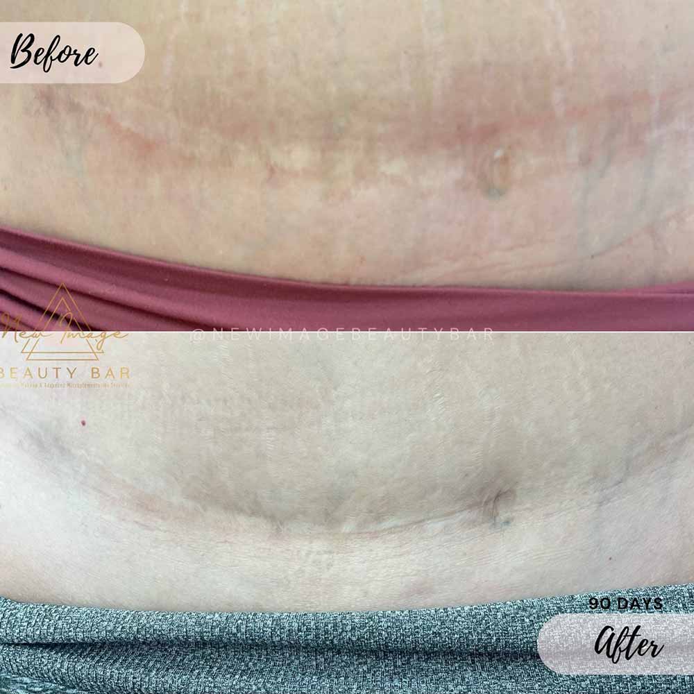 what is tummy tuck scar camouflage