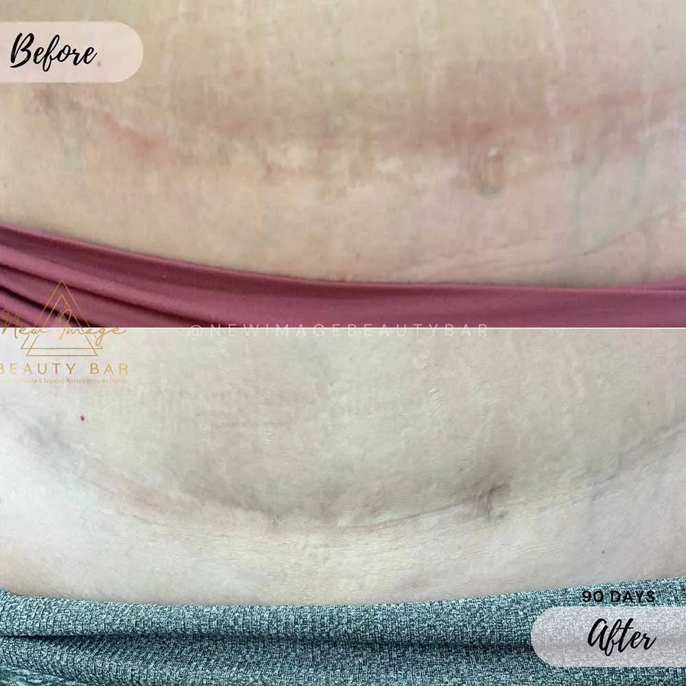 Tummy tuck scar tattoo