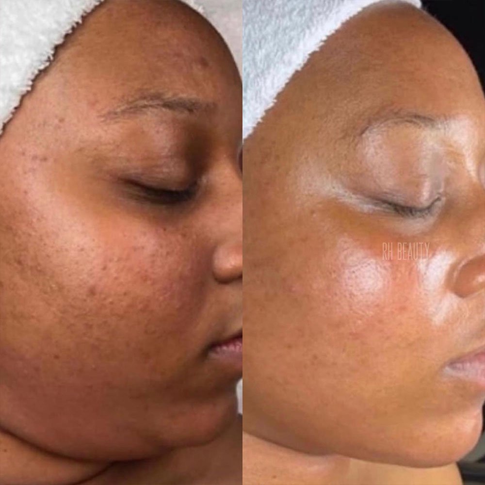 Is It Safe to Do a Jessner Peel on African American Skin