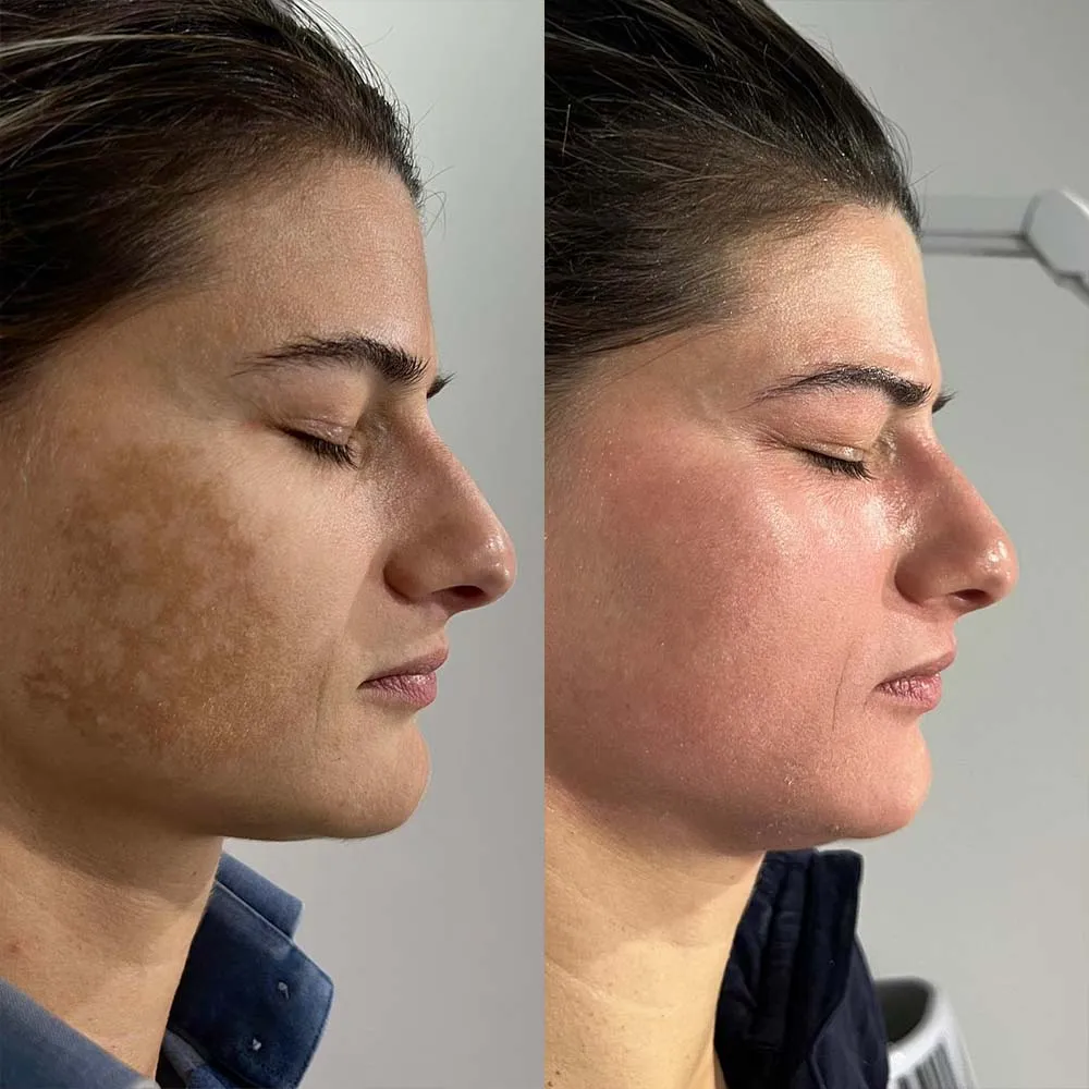 Lactic Acid Peel during pregnancy