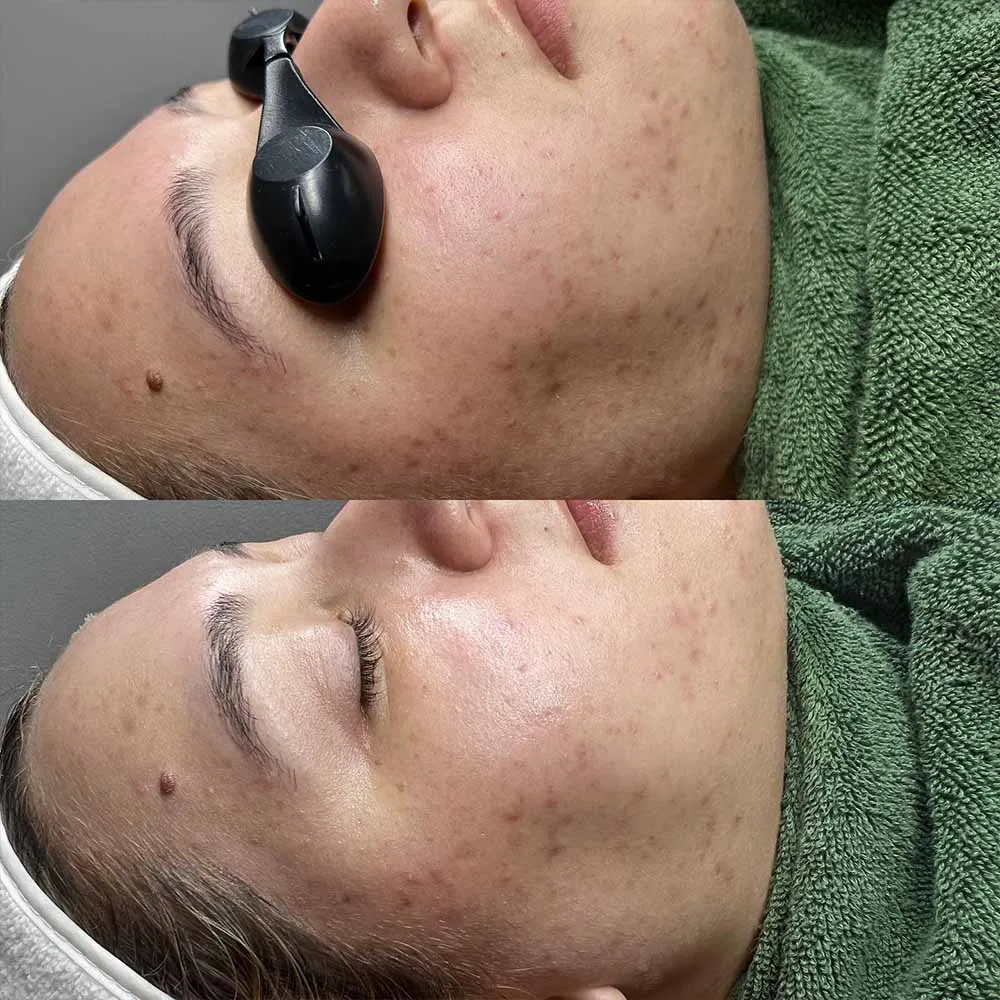 salicylic acid peel things to know