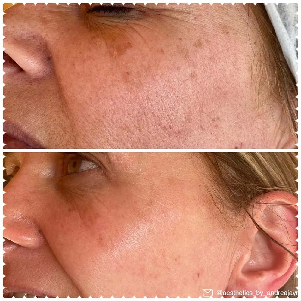 Salicylic Acid Peel for Hyperpigmentation