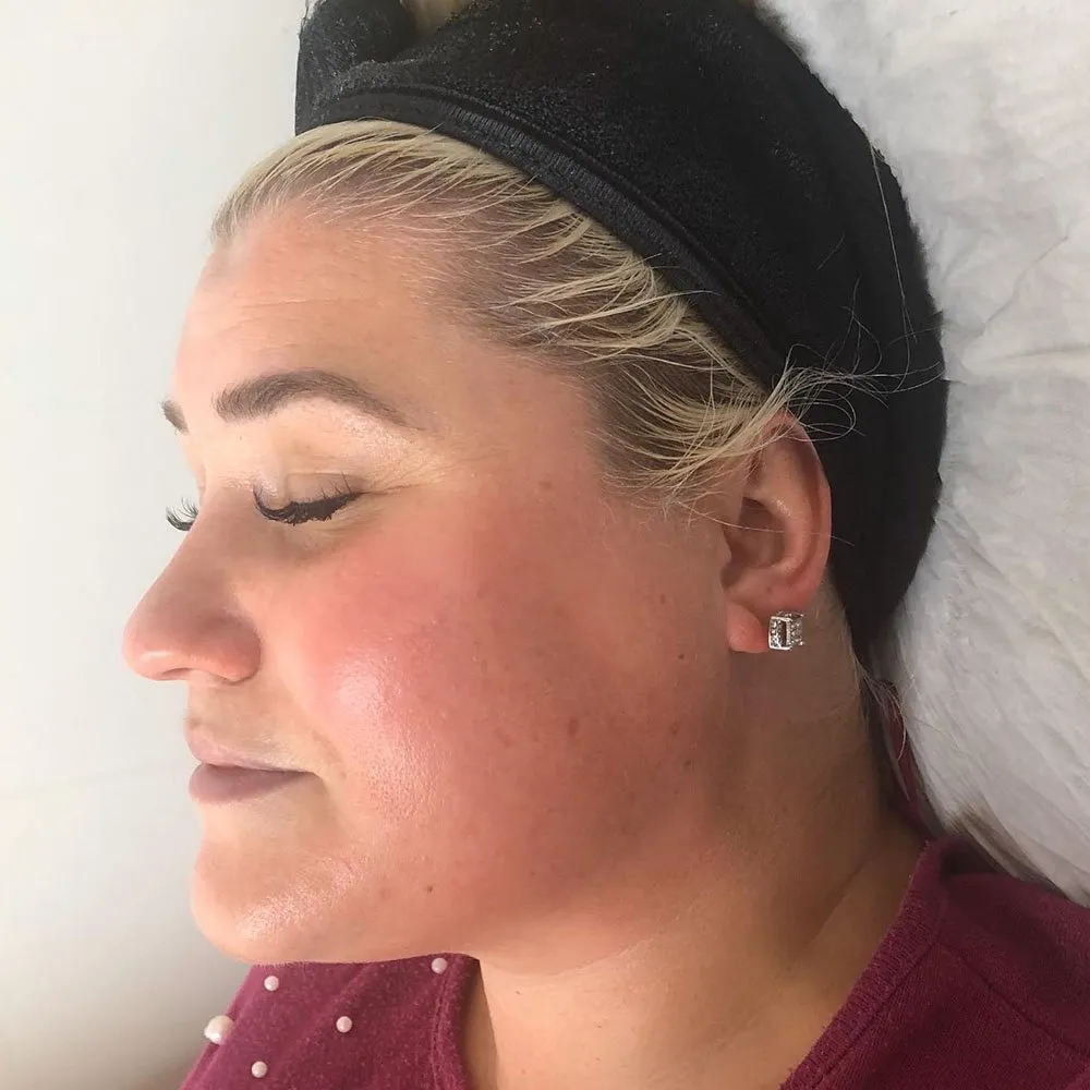 Salicylic Acid Peel for Large Pores 