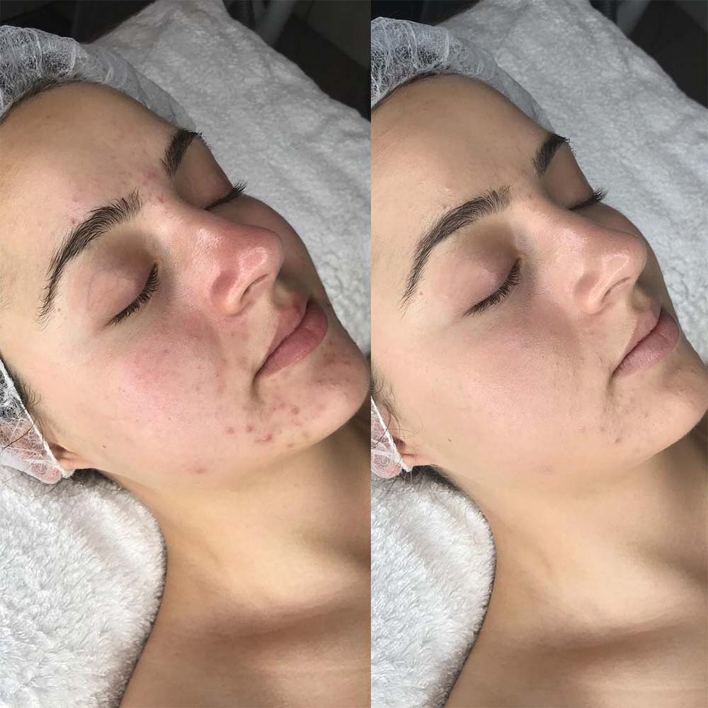 Salicylic shop acid peel
