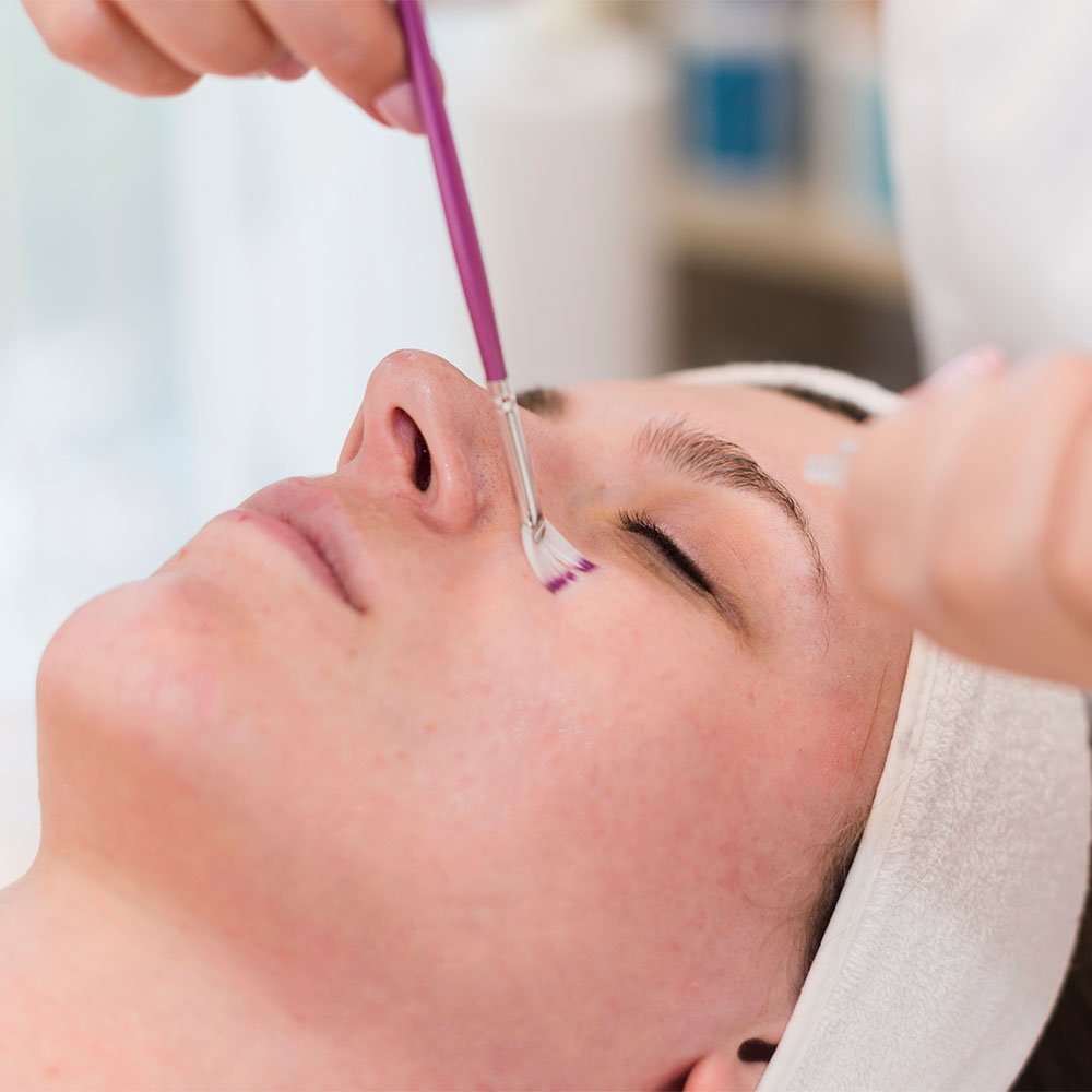 what is a lactic acid peel