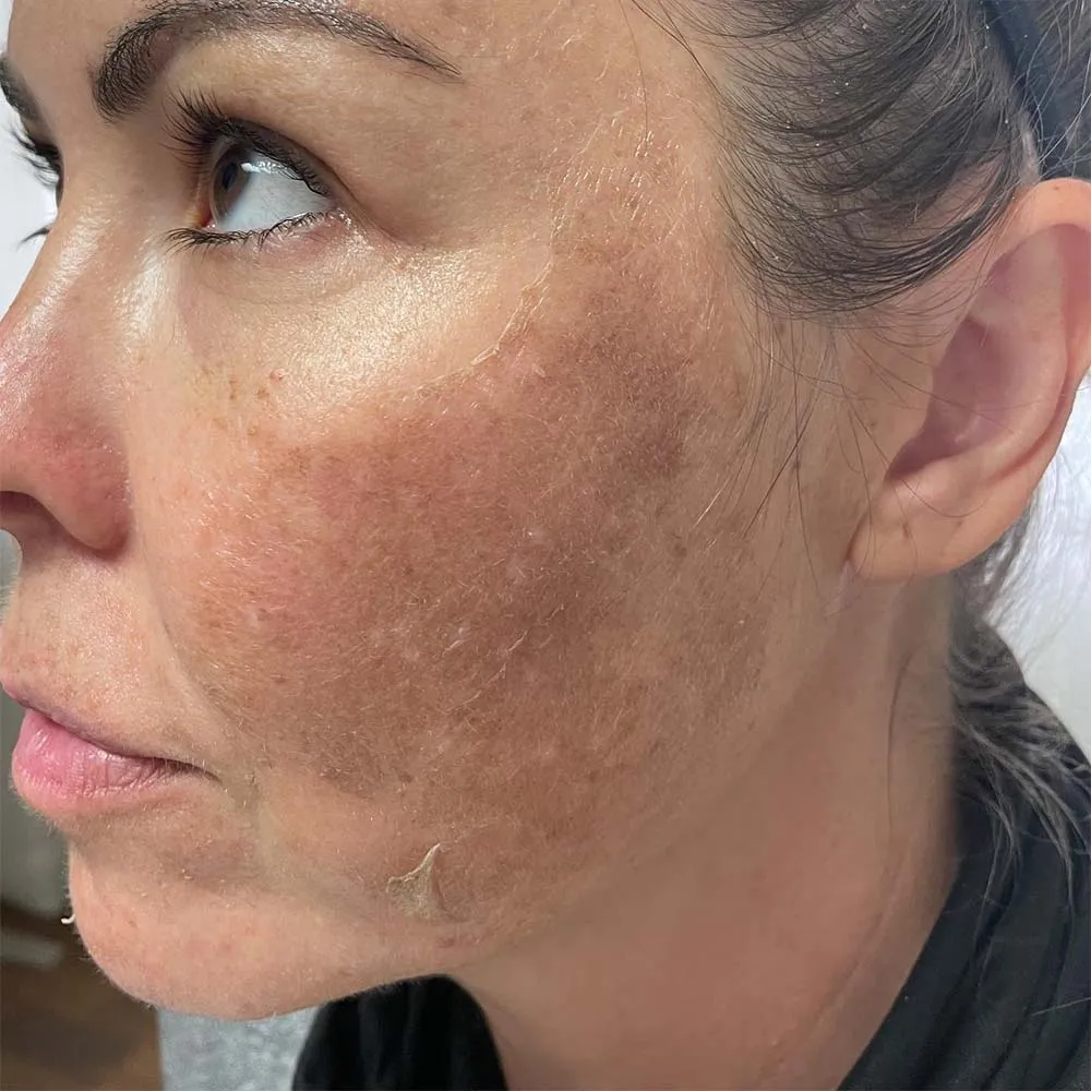 Can Chemical Peels Make Melasma Worse?