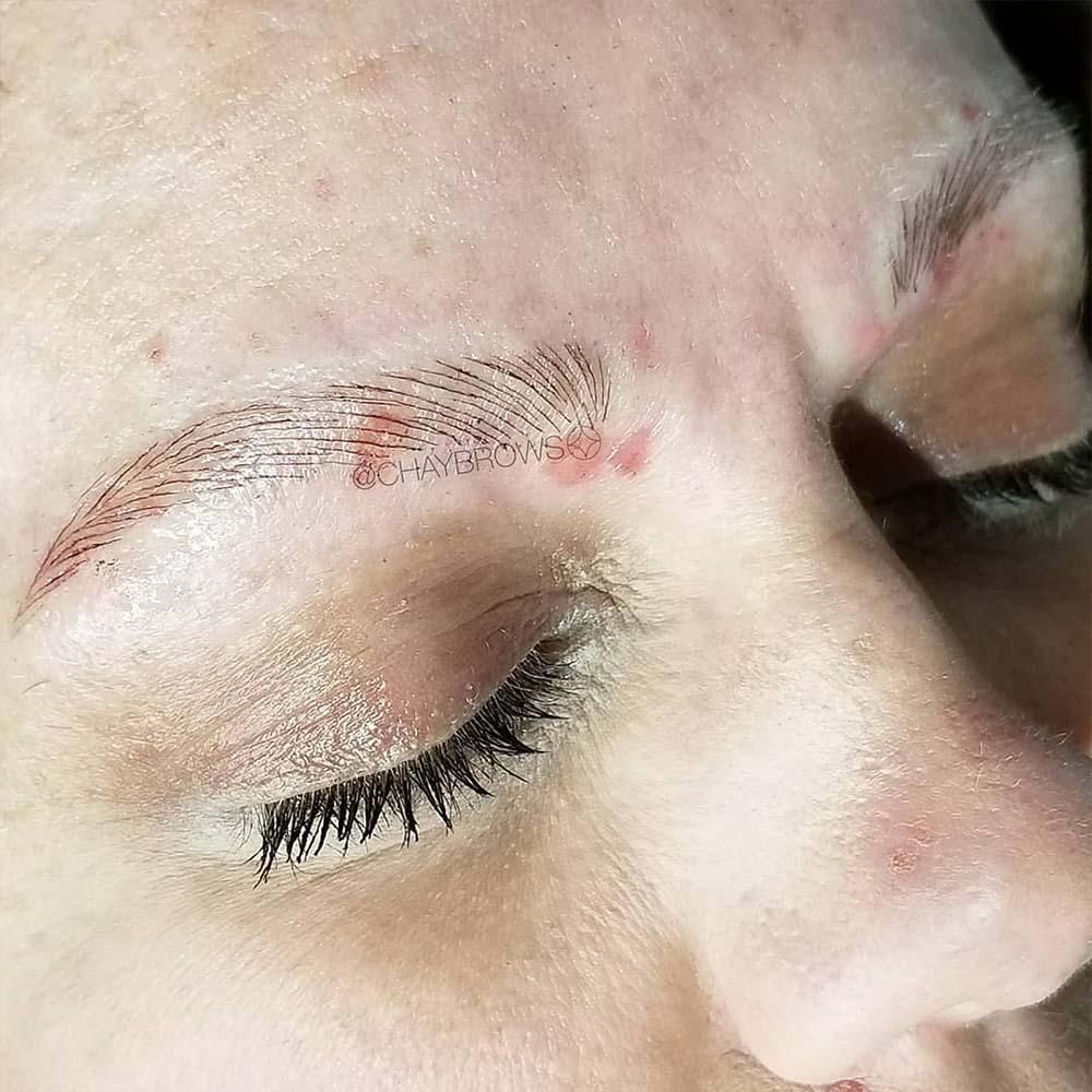 Eczema or Psoriasis on eyebrows
