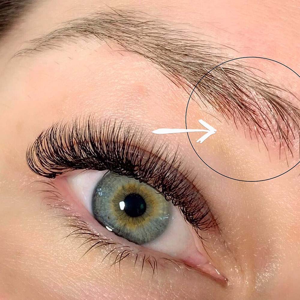 eyebrow dandruff caused by seborrheic dermatitis