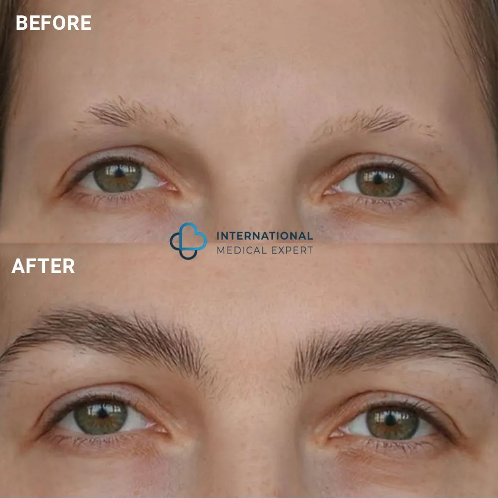 Eyebrow sales transplant cost