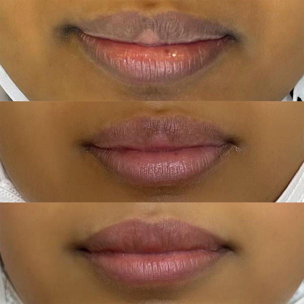 laser lip lightening healing and aftercare