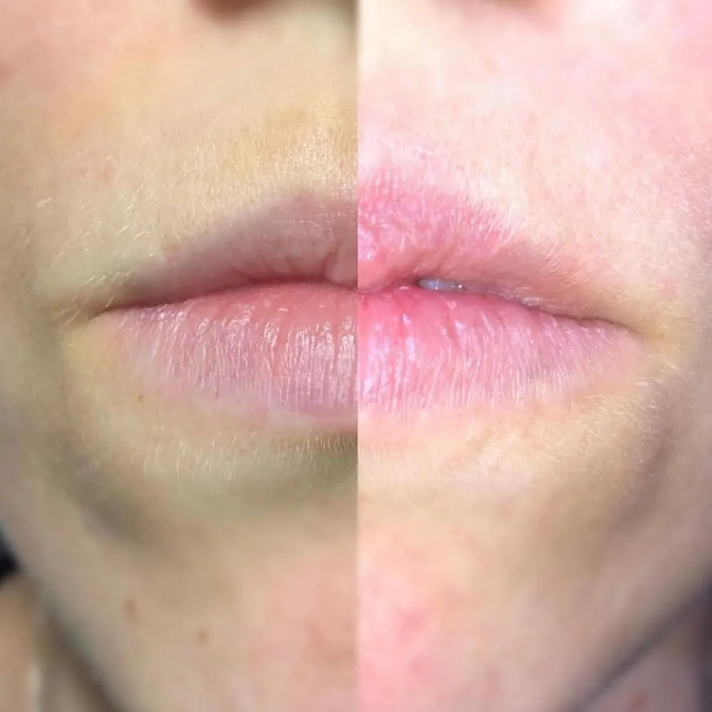 laser lip plumping