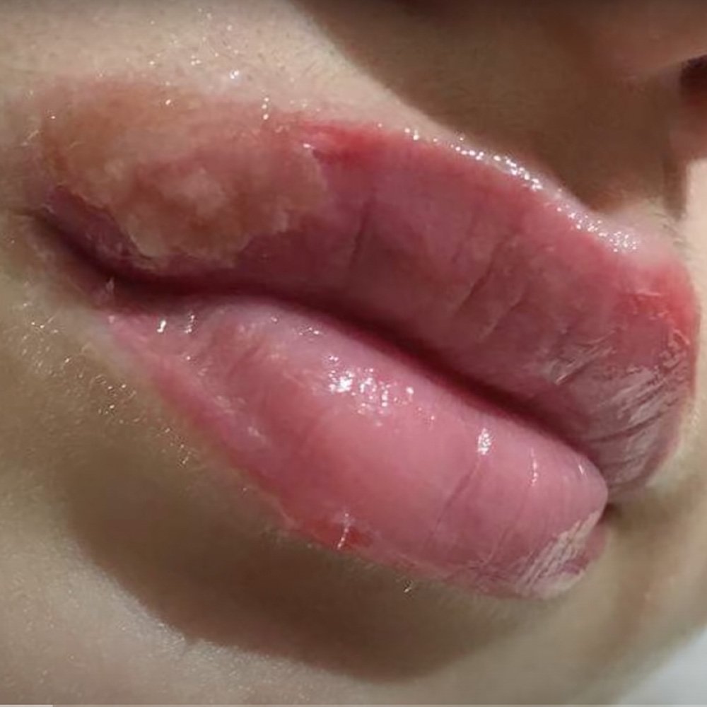 getting herpes after lip blush