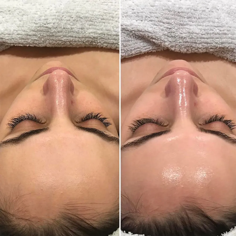 kojic acid peel