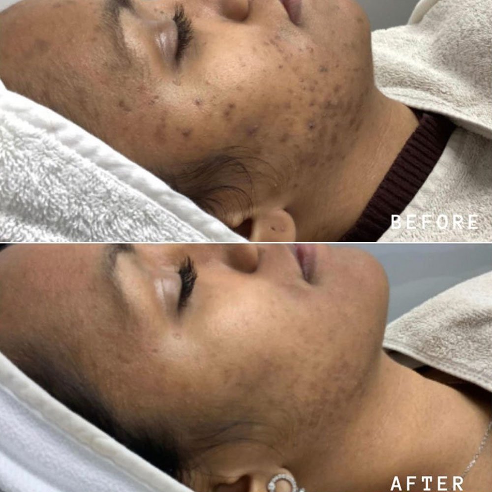 AHA chemical peel for acne scars