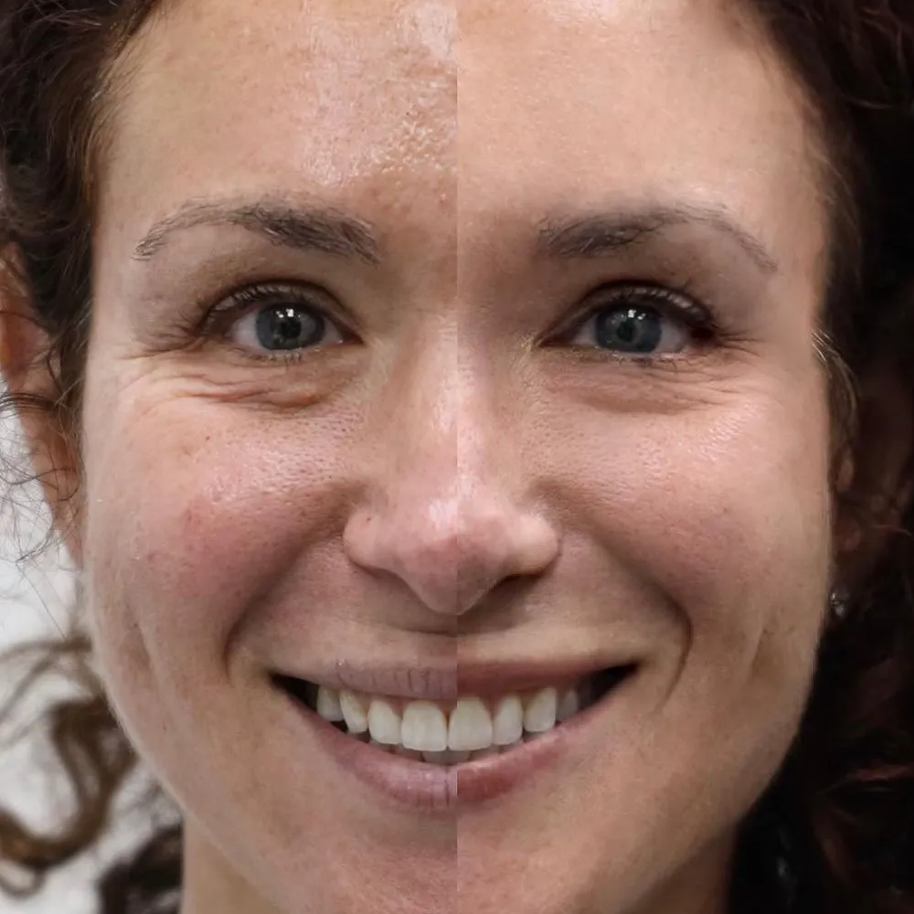 CO2 Laser Facial Rejuvenation: Fix Fine Lines, Wrinkles, Sun Damage &  Stretch Marks