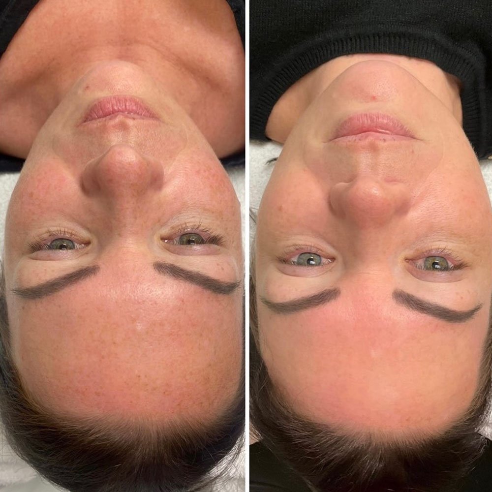 IPL for sun spots
