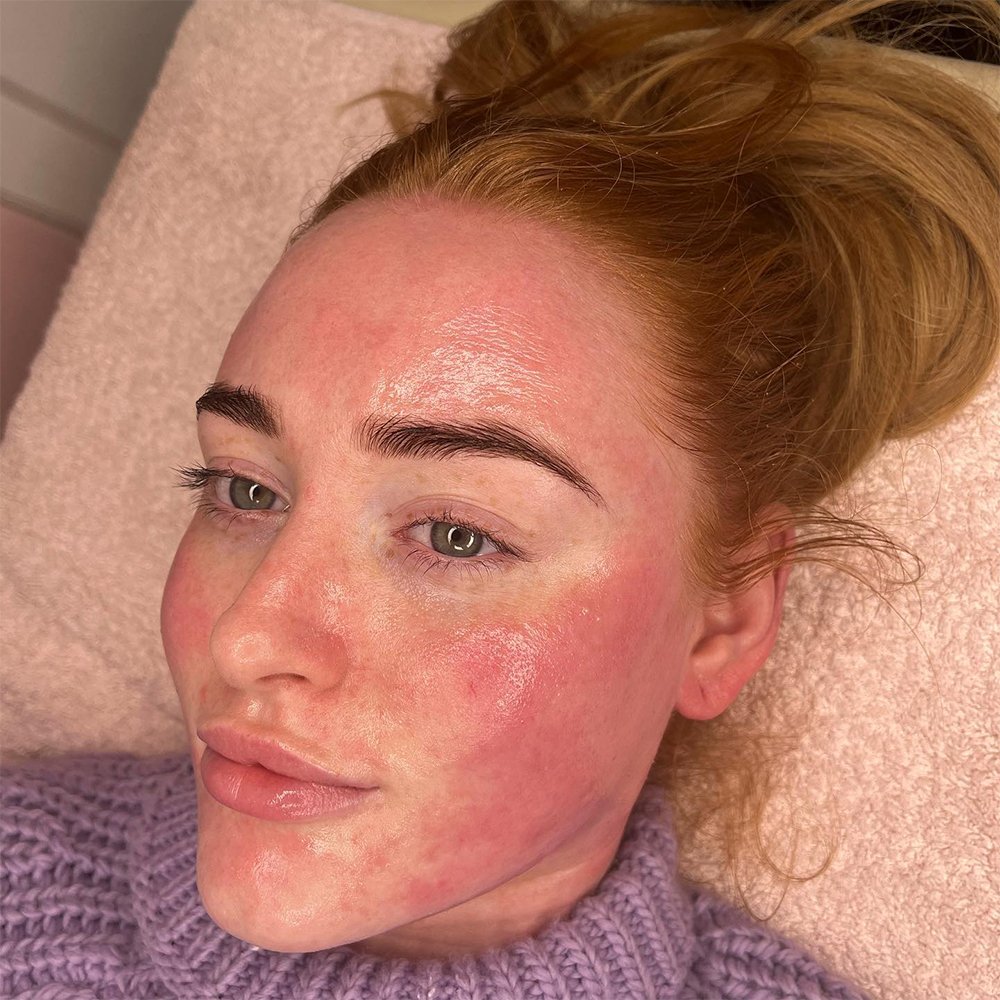 is there any pain after a chemical peel
