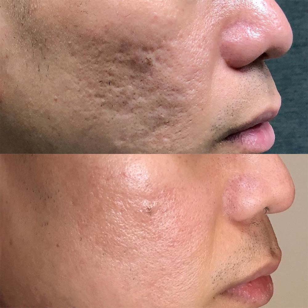 Co2 laser acne scars deals
