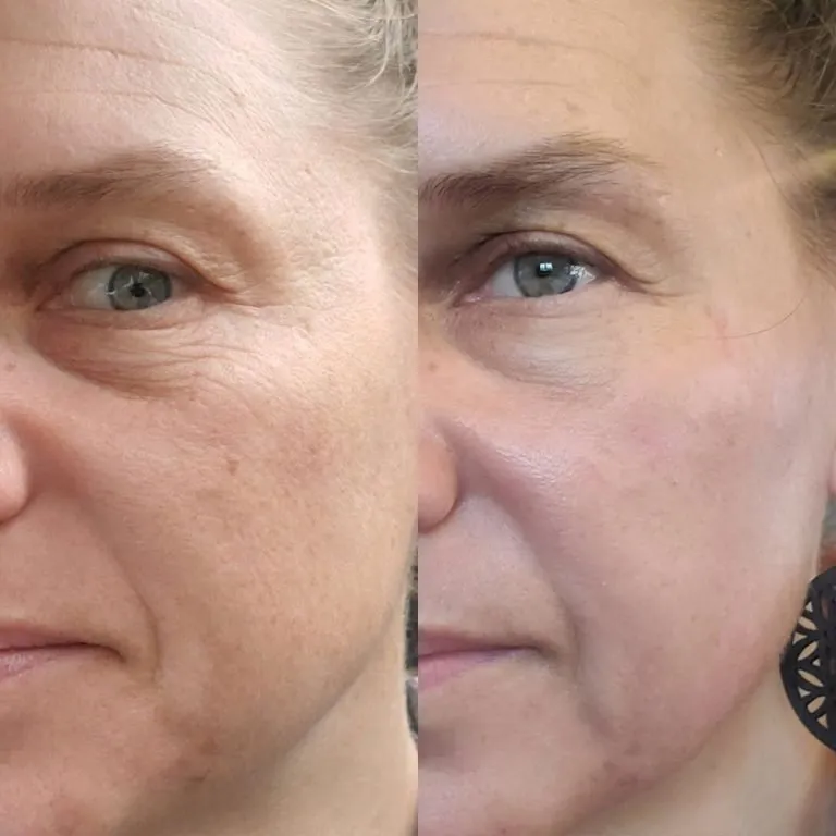 Erbium Laser Resurfacing All You Need to Know