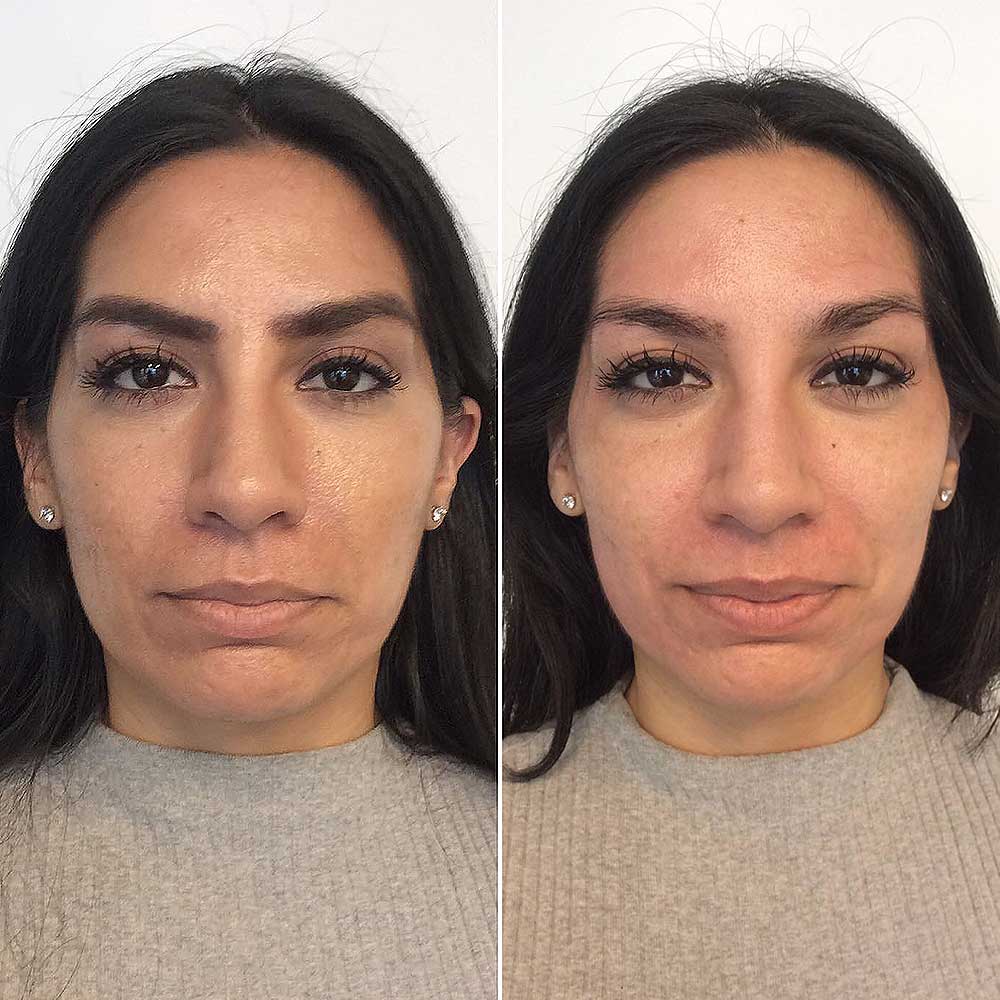 Microcurrent Facial All You Need to Know