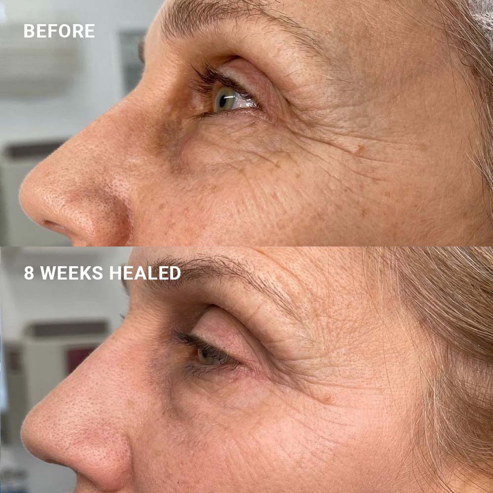 Plasma Pen Treatment Cost in US, UK & Australia