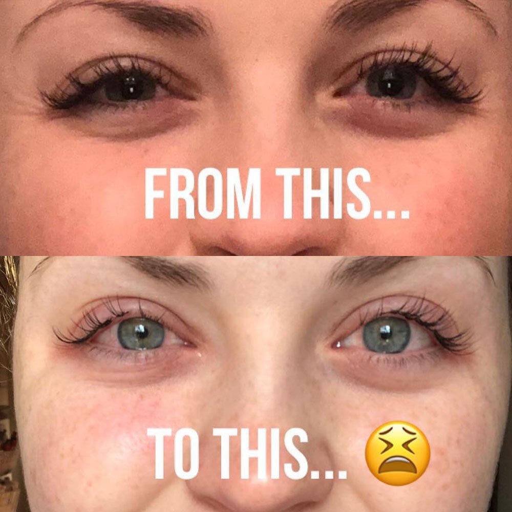 lash extensions allergic reaction