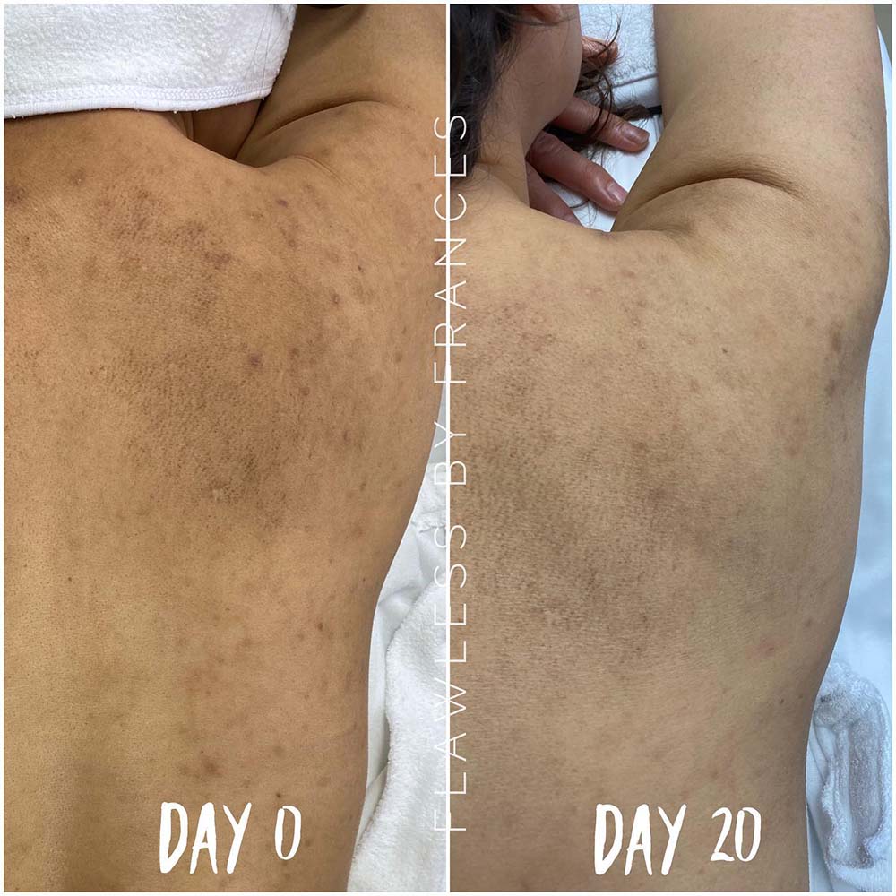 Chemical Peel for Body Pigmentation 