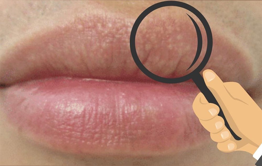 what are fordyce spots on lips