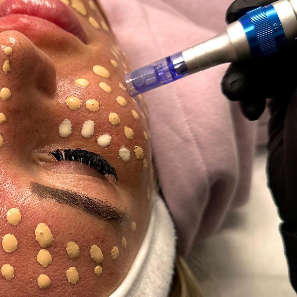 Woman getting a BB glow treatment