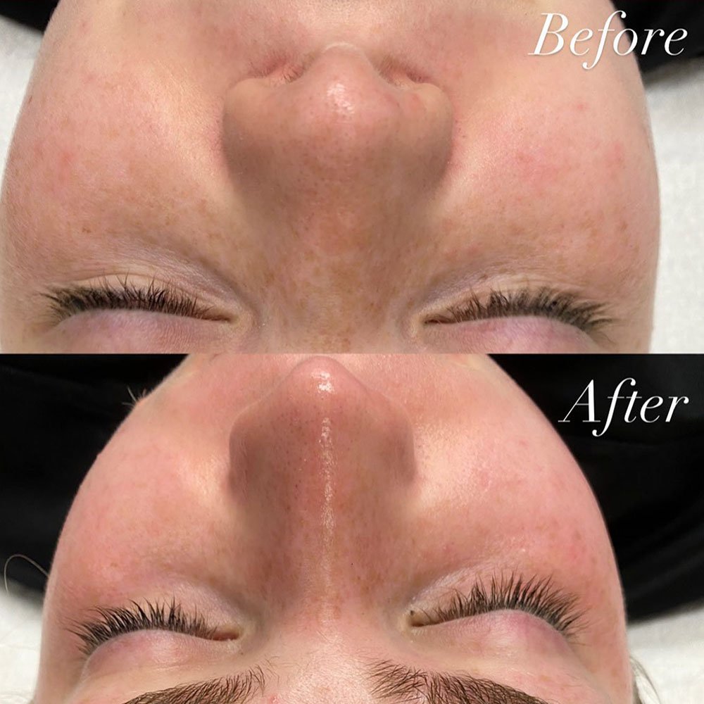 microdermabrasion pores