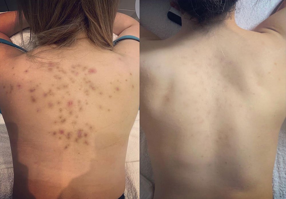 LED Light Therapy: All You Need to Know 16 acne outbreaks led therapy